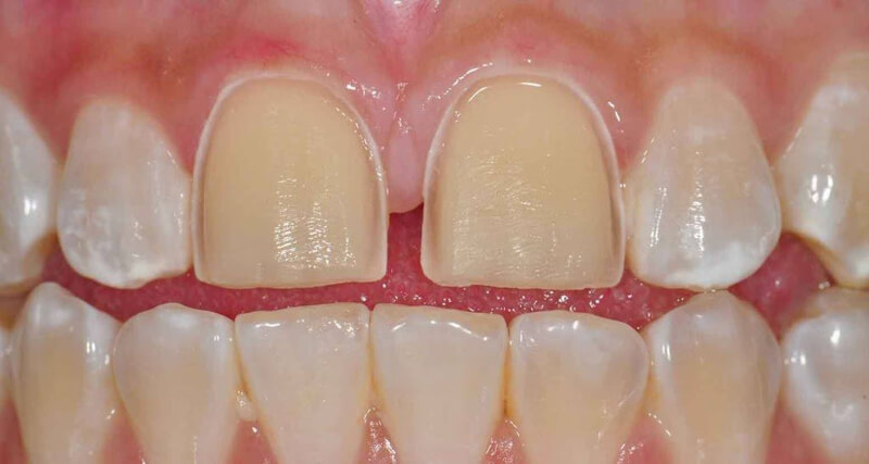 Niềng răng cửa mất bao lâu