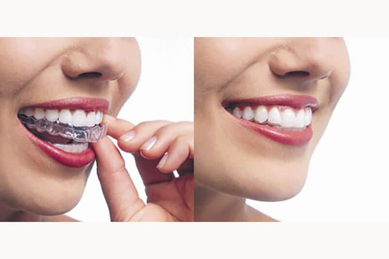 niềng răng hô trả góp