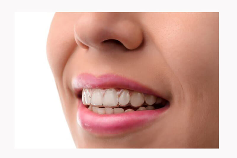 niềng răng invisalign có hiệu quả không