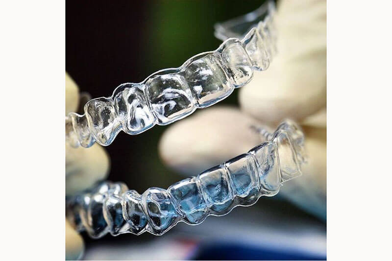 niềng răng trong suốt giá bao nhiêu