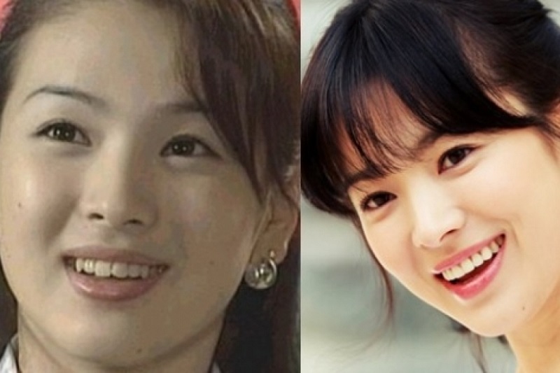 sao Hàn niềng răng