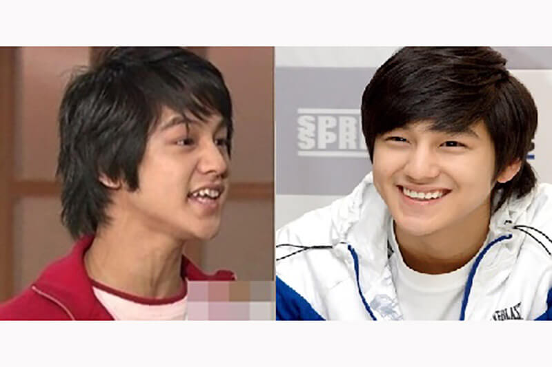 sao Hàn niềng răng