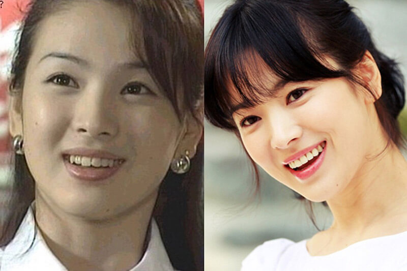 sao Hàn niềng răng