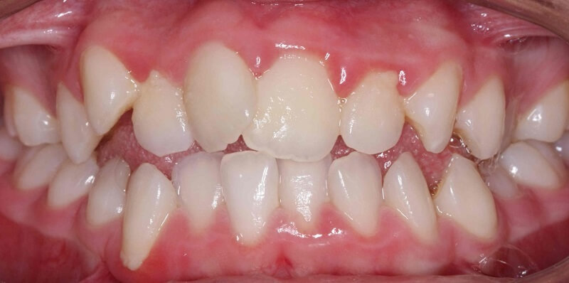 Răng lệch lạc nên niềng hay bọc sứ