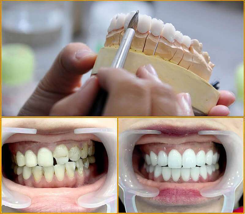 Răng lệch lạc nên niềng hay bọc sứ