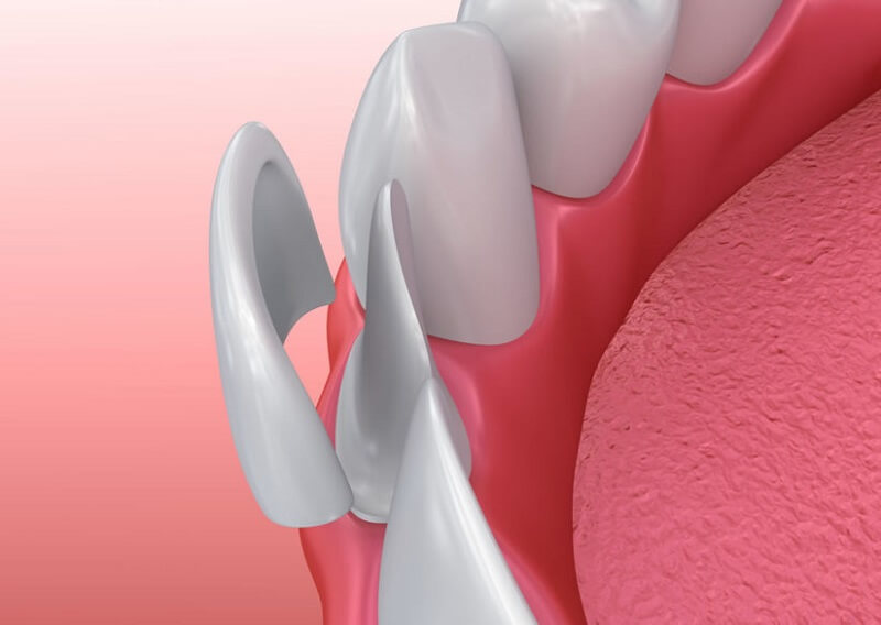 bọc răng sứ không mài