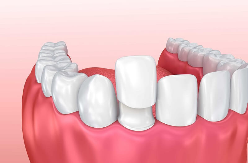 bọc răng sứ không mài