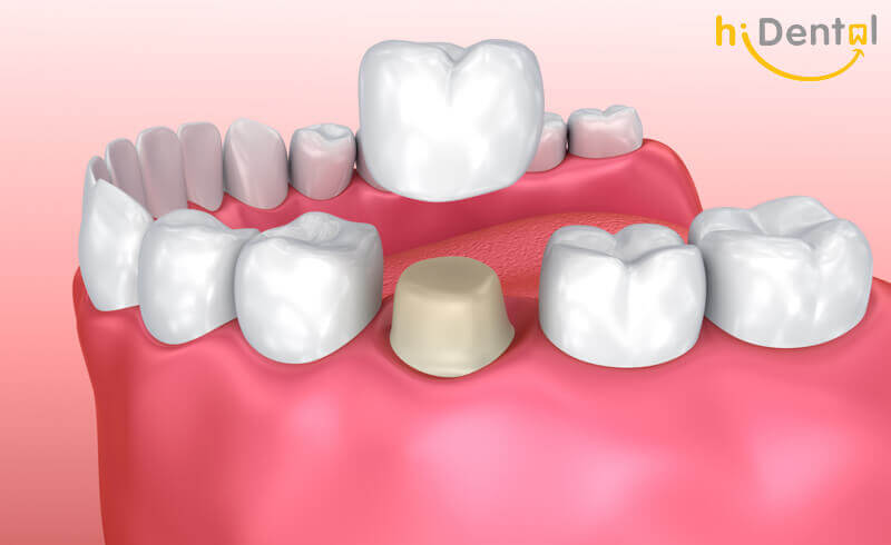Bọc răng sứ có đau không