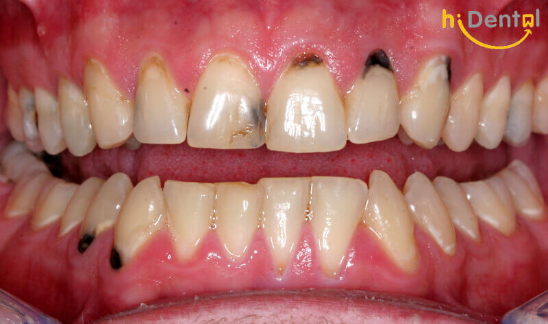 Bọc răng sứ có đau không