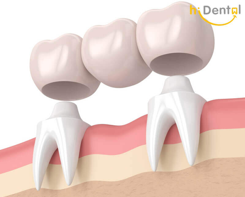 Bọc răng sứ có đau không