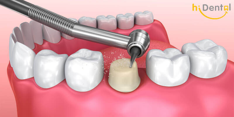 Bọc răng sứ có đau không