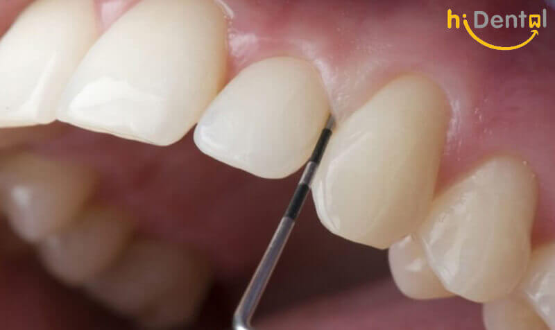 Bọc răng sứ có hại không