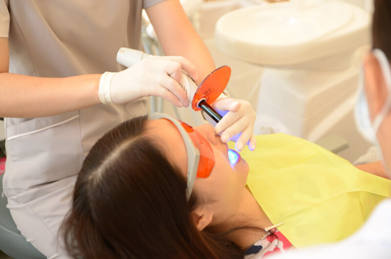 bao lâu tẩy trắng răng 1 lần