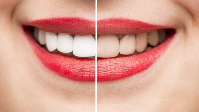 bao lâu tẩy trắng răng 1 lần