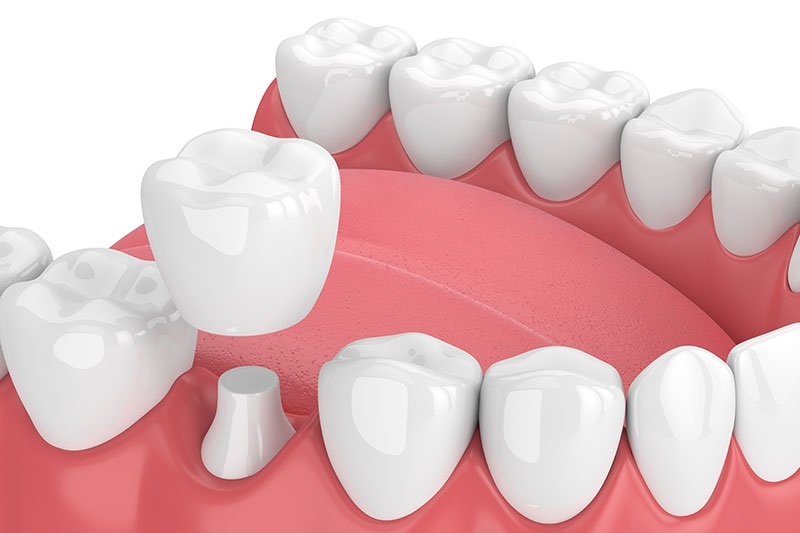 bọc lại răng sứ