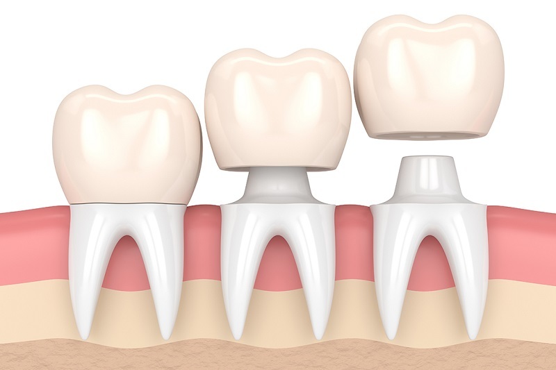 bọc lại răng sứ