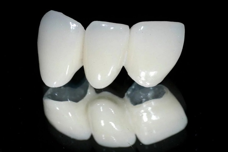 Bọc mão răng sứ