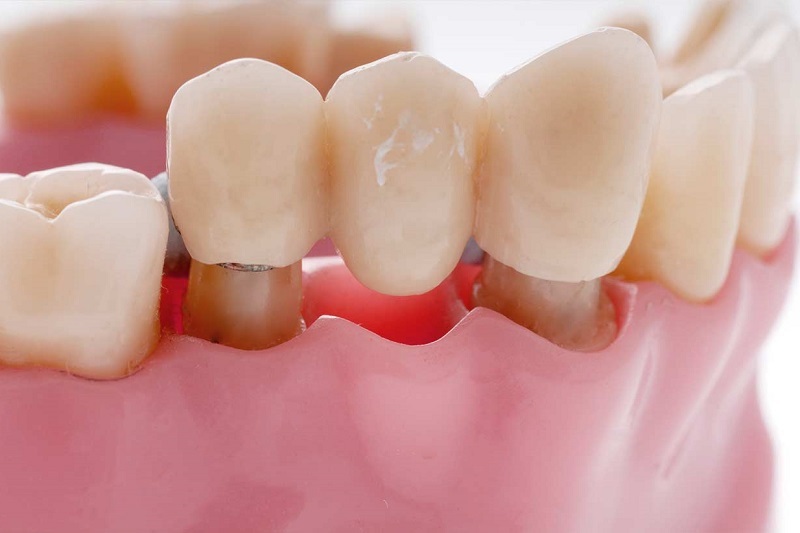 Bọc mão răng sứ