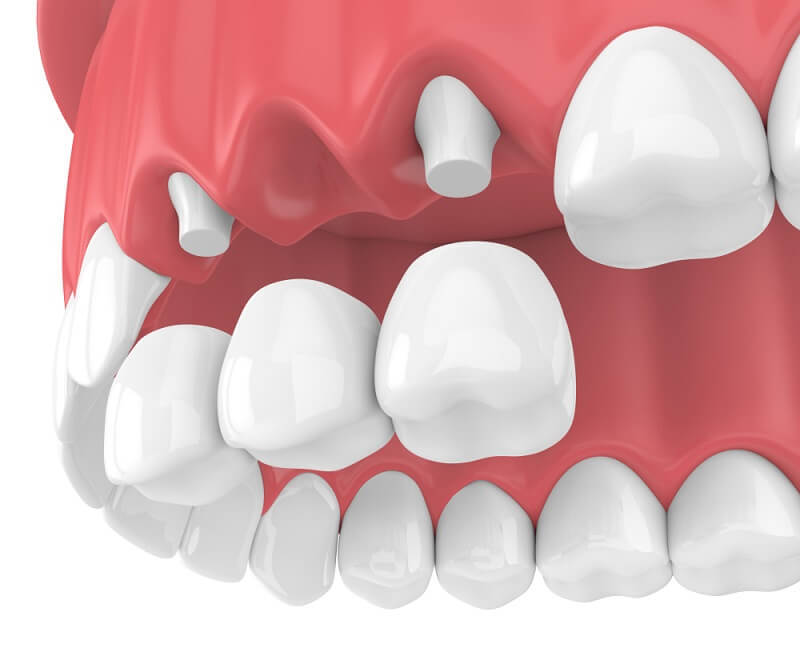 Bọc răng sứ bắc cầu