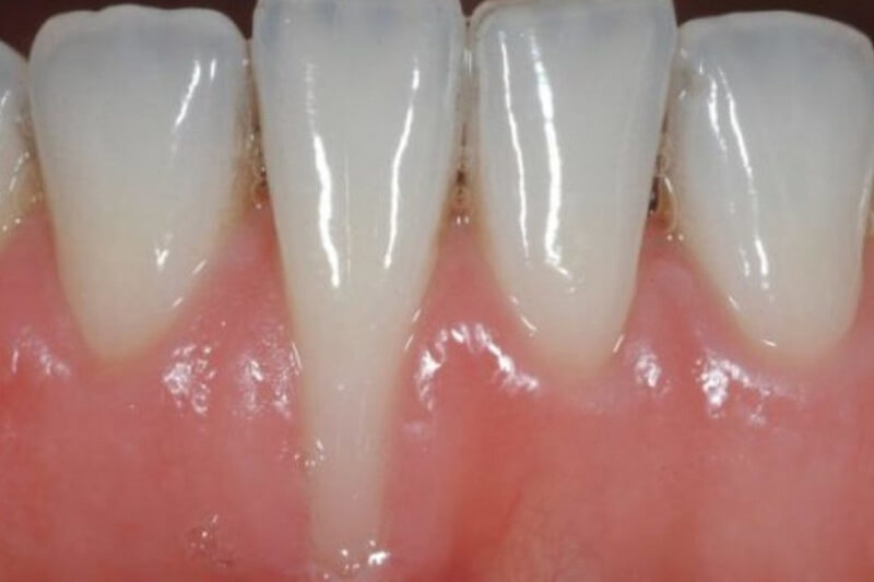 bọc răng sứ bị tụt lợi