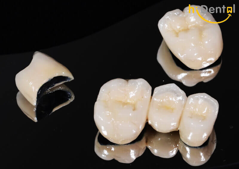 Bọc răng sứ cao cấp