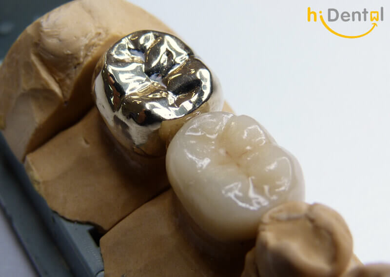 Bọc răng sứ cao cấp