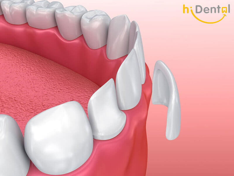 Bọc răng sứ cao cấp
