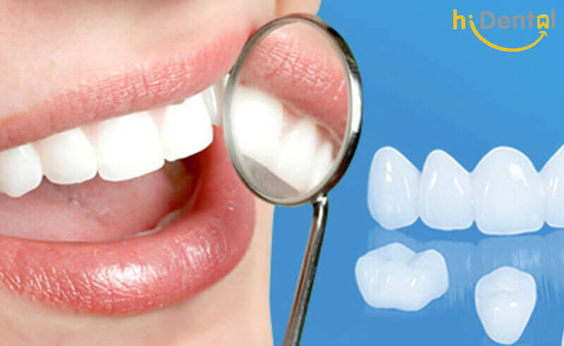 Bọc răng sứ cao cấp