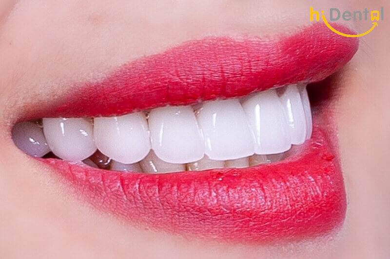 Bọc răng sứ cao cấp