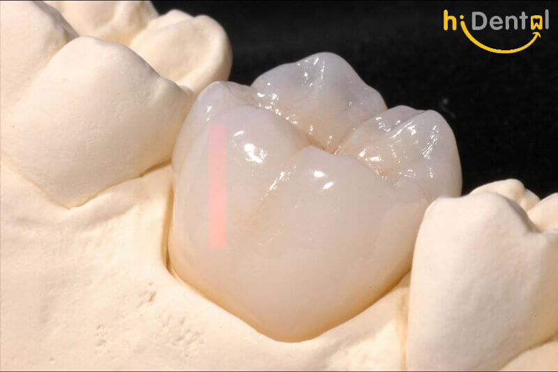 Bọc răng sứ Cercon