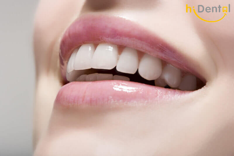 Bọc răng sứ Cercon