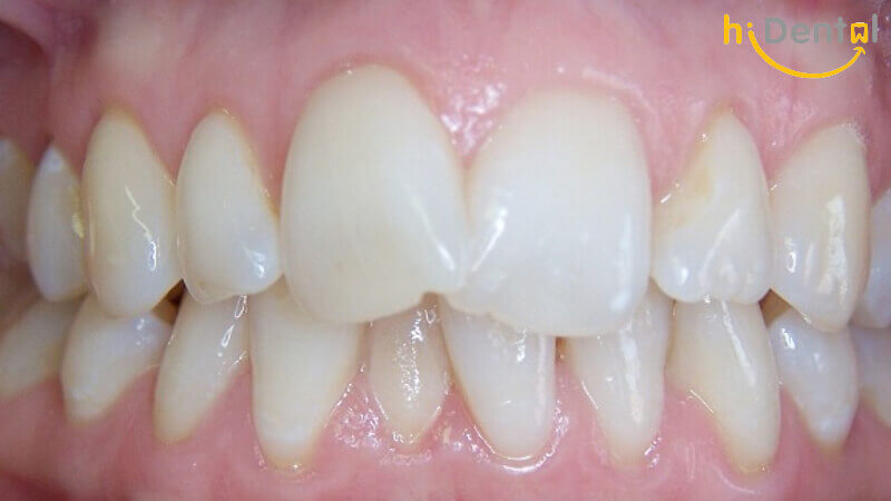 Bọc răng sứ cho răng cửa