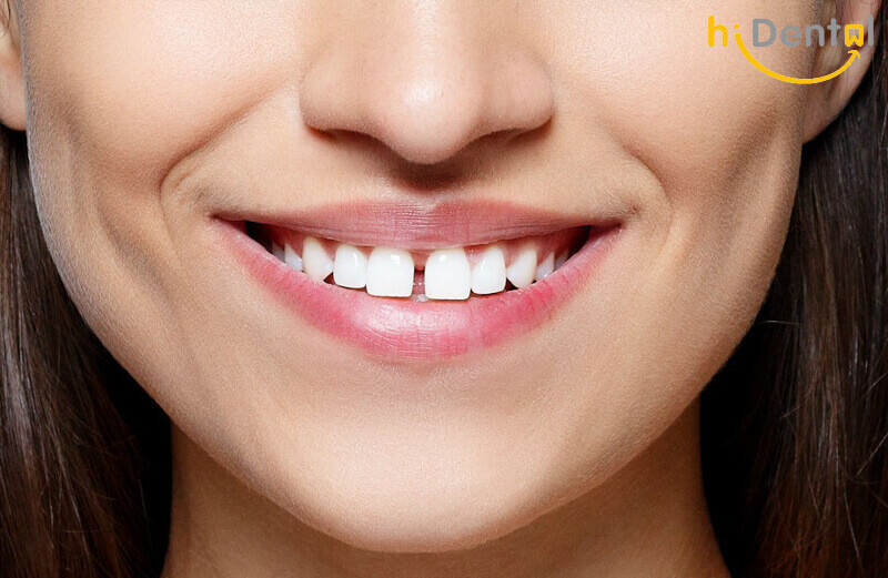 Bọc răng sứ cho răng cửa