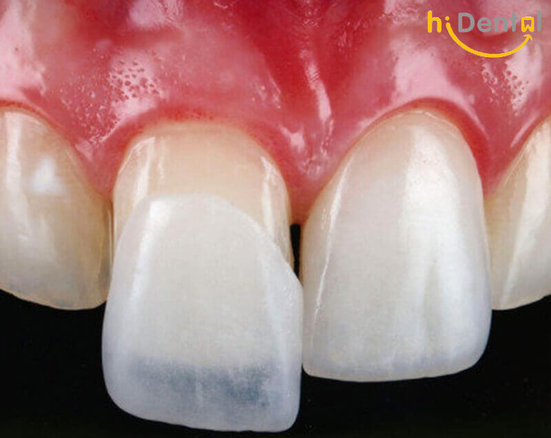Bọc răng sứ cho răng cửa