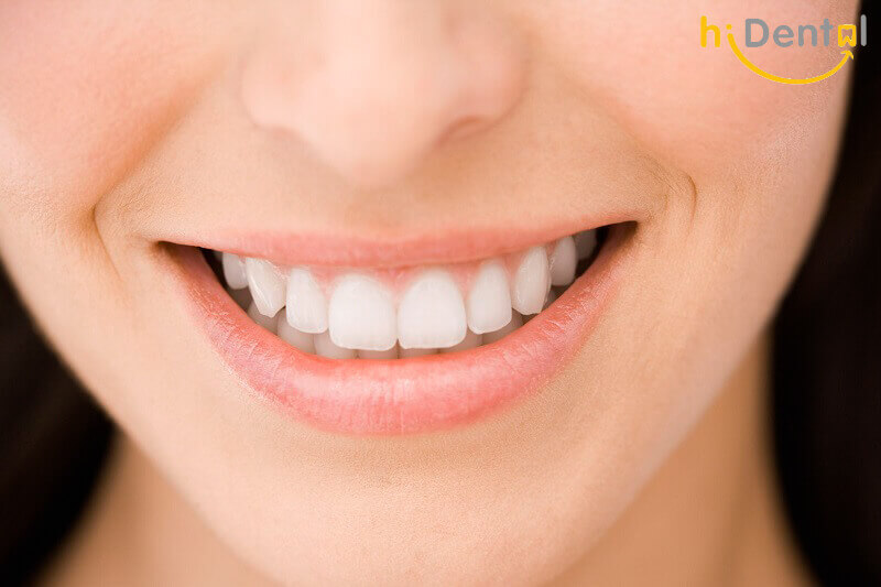 Bọc răng sứ cho răng cửa