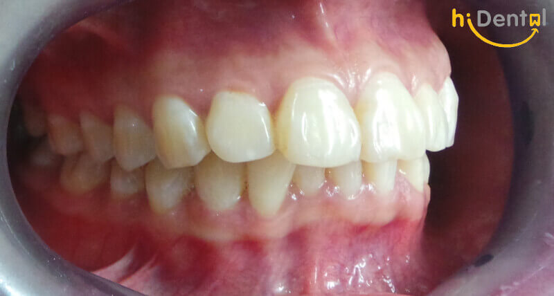 Bọc răng sứ cho răng hô