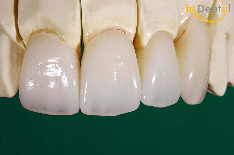 Bọc răng sứ cho răng hô