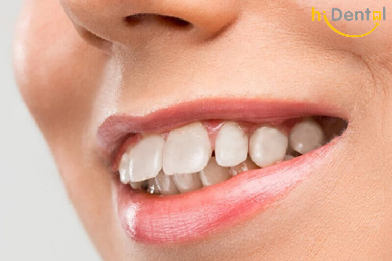 Bọc răng sứ cho răng hô