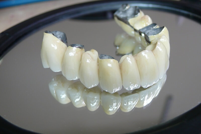 Bọc răng sứ có bền không