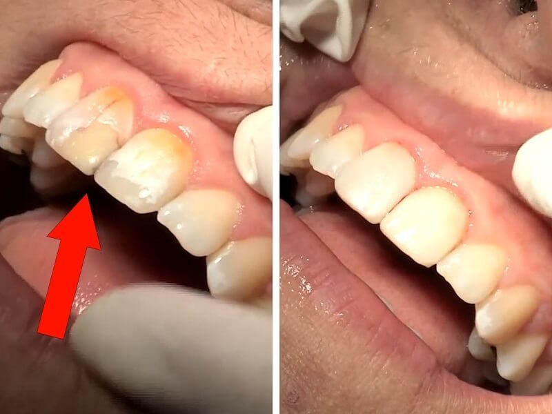 Bọc răng sứ có bền không