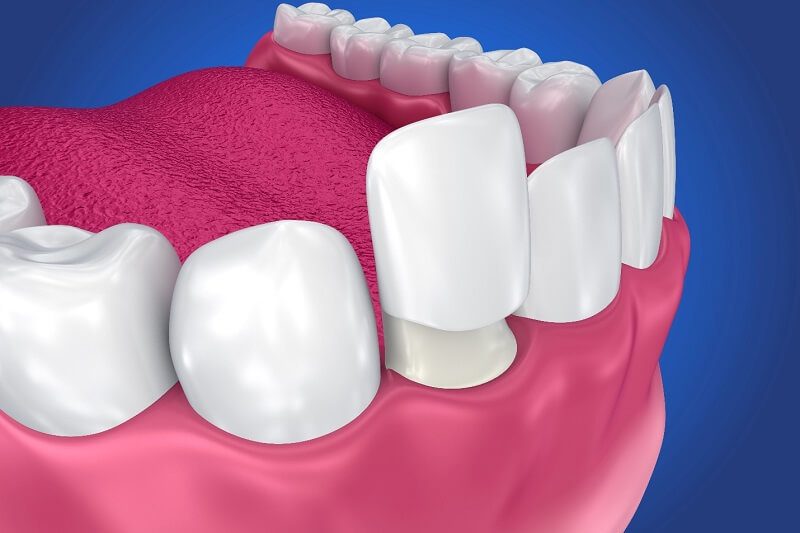 Bọc răng sứ có bền không