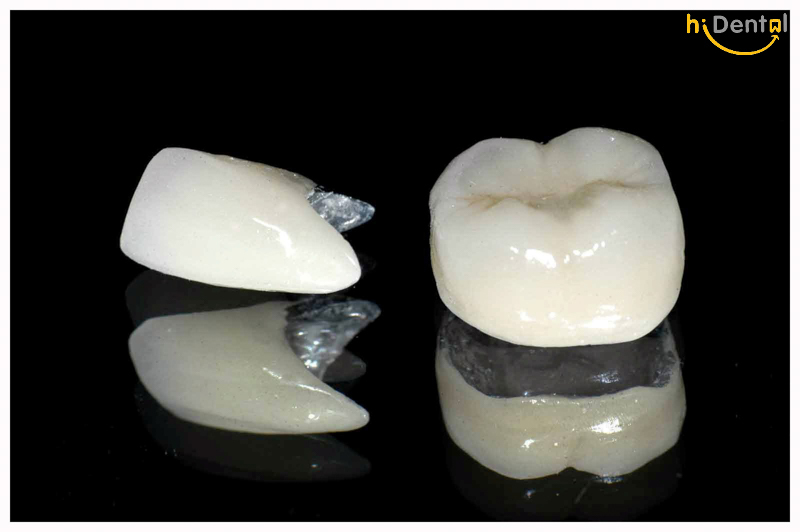 Bọc răng sứ kim loại