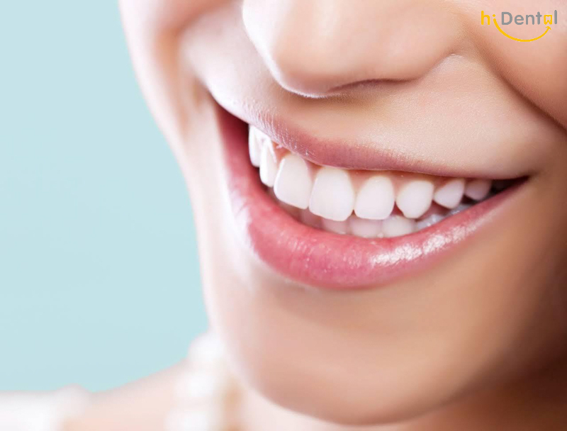 Bọc răng sứ kim loại