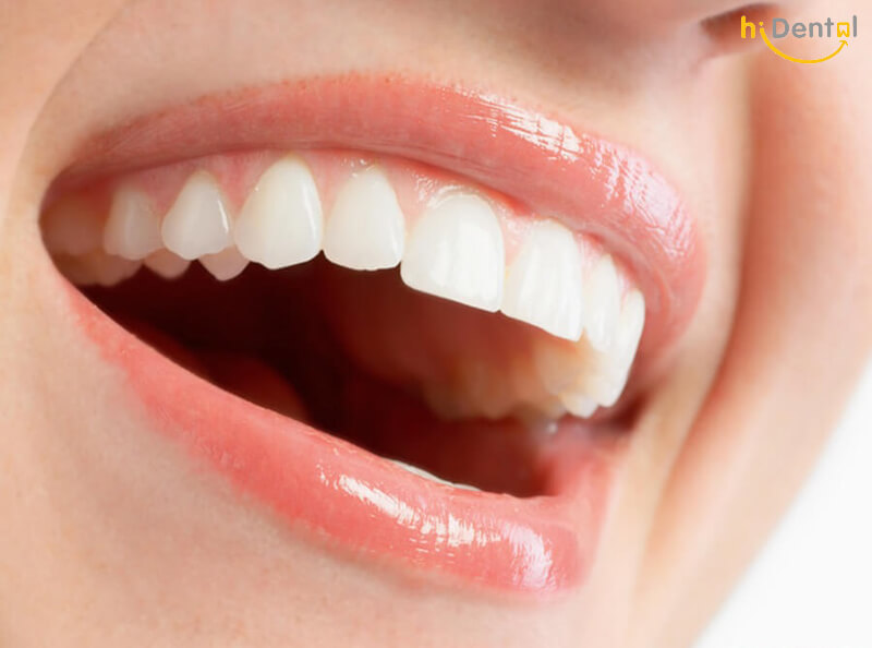 Bọc răng sứ nguyên hàm bao nhiêu tiền