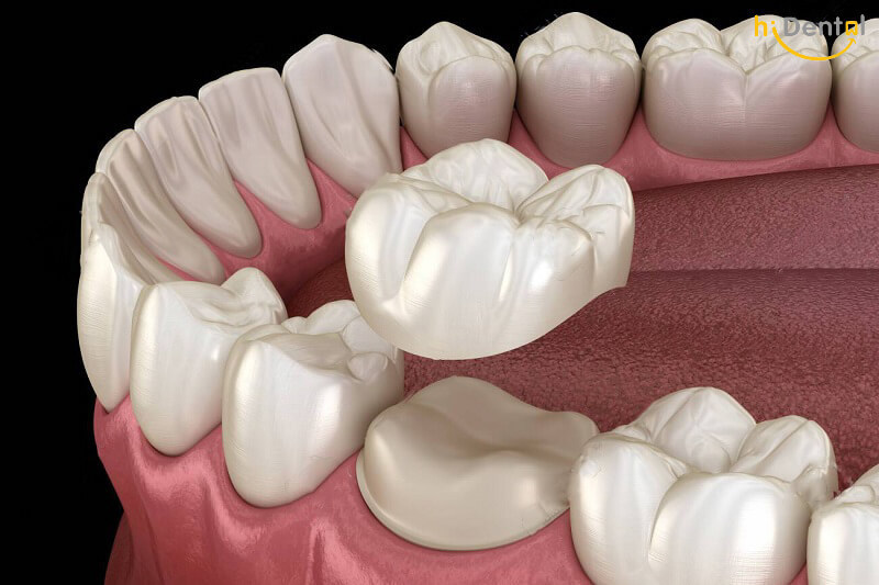 Bọc răng sứ răng hàm