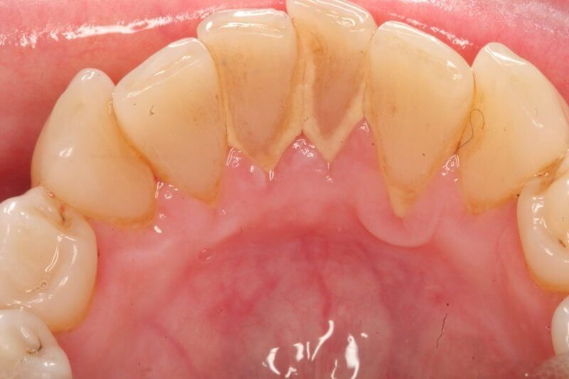 cách giữ răng trắng sau khi tẩy