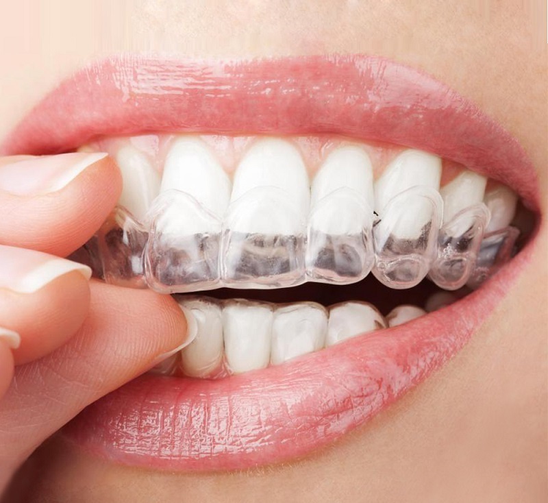 Cách sử dụng máng tẩy trắng răng