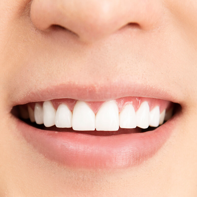 chi phí niềng răng cửa thưa