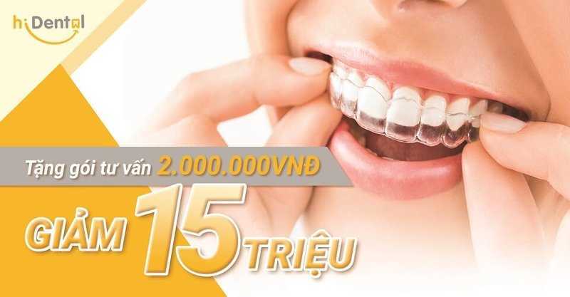 chi phí niềng răng trong suốt