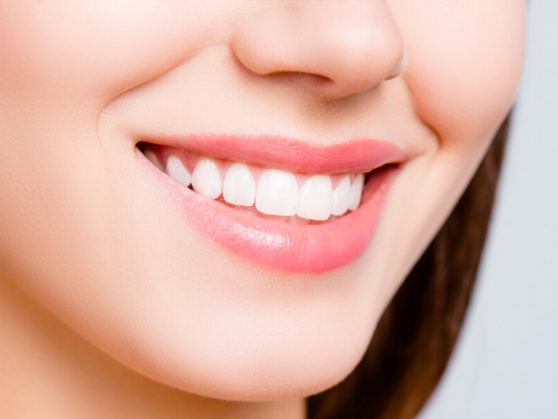 Có nên tẩy trắng răng